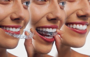 invisalign near me grand traverse mi