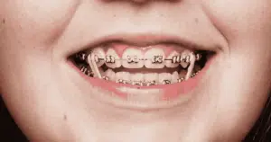 braces kit