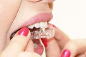 clear-braces-being-remove