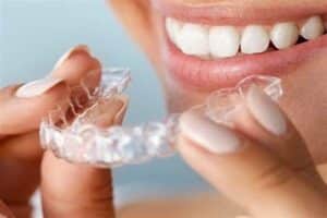 clear-braces-being-worn-by-woman