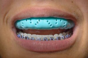 braces and mouthguard
