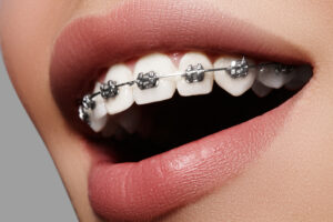 Types of Braces