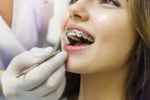 Orthodontist adjusting traditional metal braces on a patient