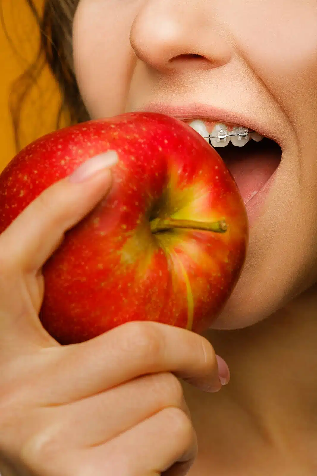 biting into apples while wearing braces