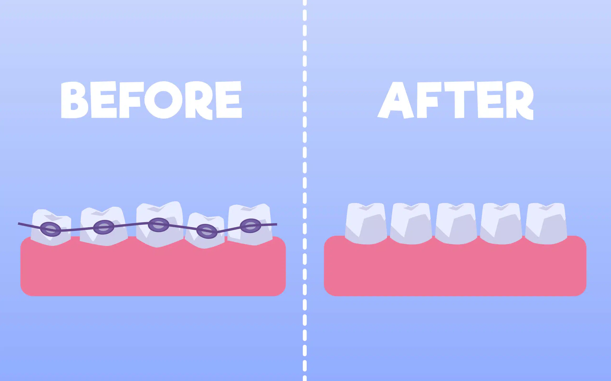 Illustration of crooked teeth with braces vs. straight teeth.