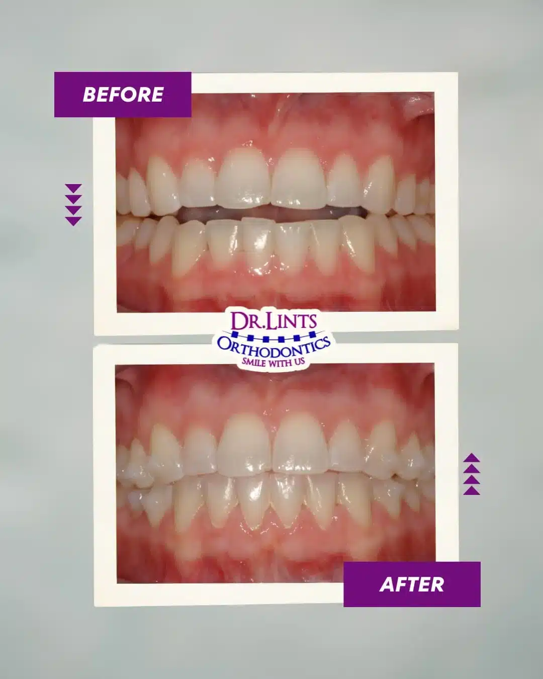 Before and after comparison of teeth alignment from Dr. Lints Orthodontics