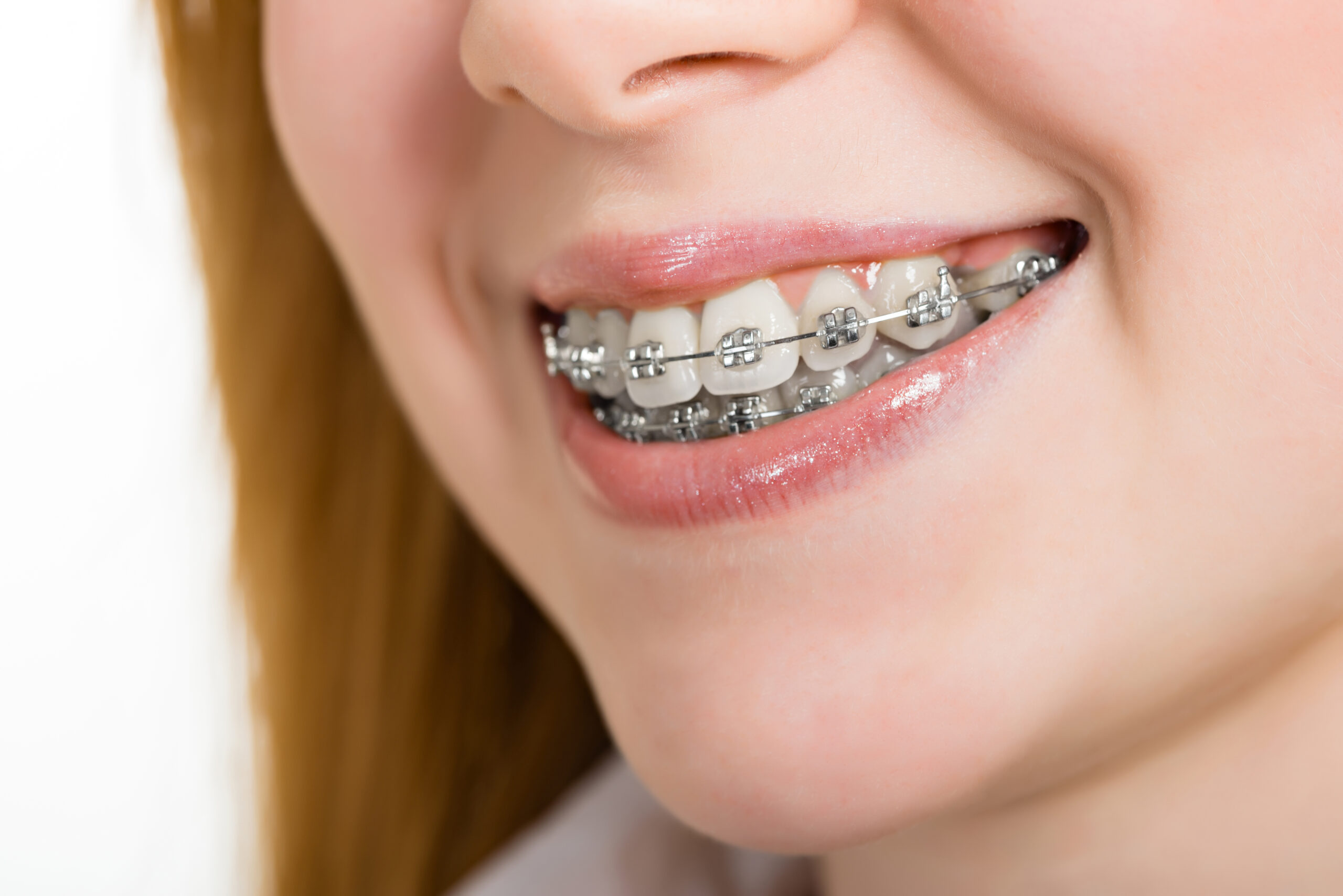 Close-up of a young woman smiling with silver metal braces.