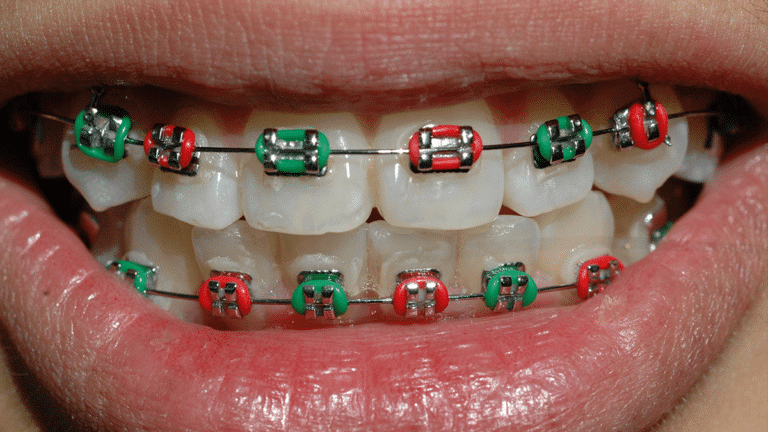 green colored braces