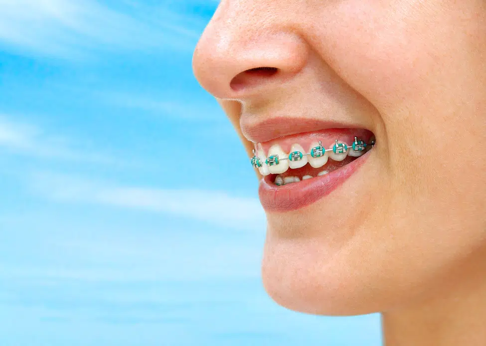 Price range and payment options for braces