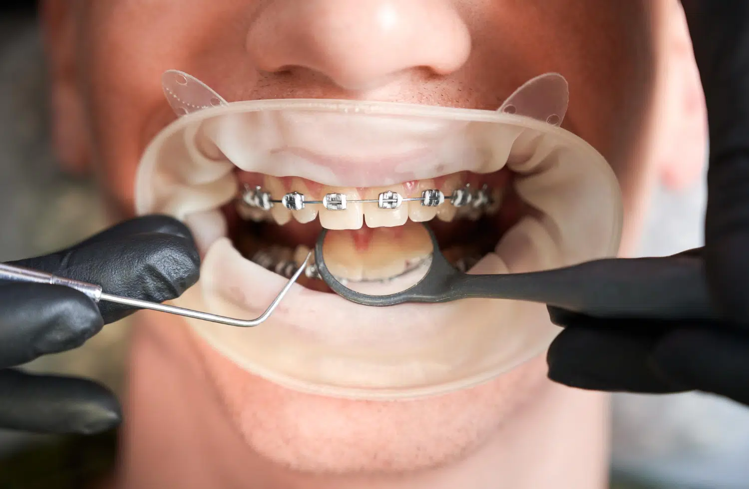 8 Health Benefits of Straight Teeth