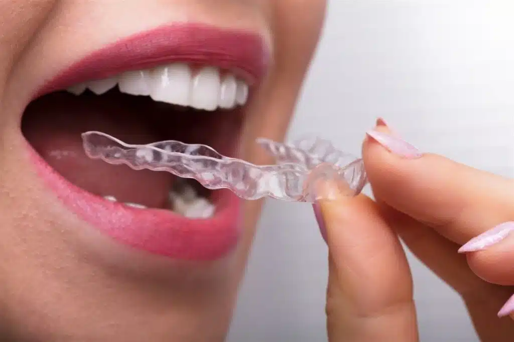 Can Invisalign Fix Overbite? Game-Changing Benefits Explained
