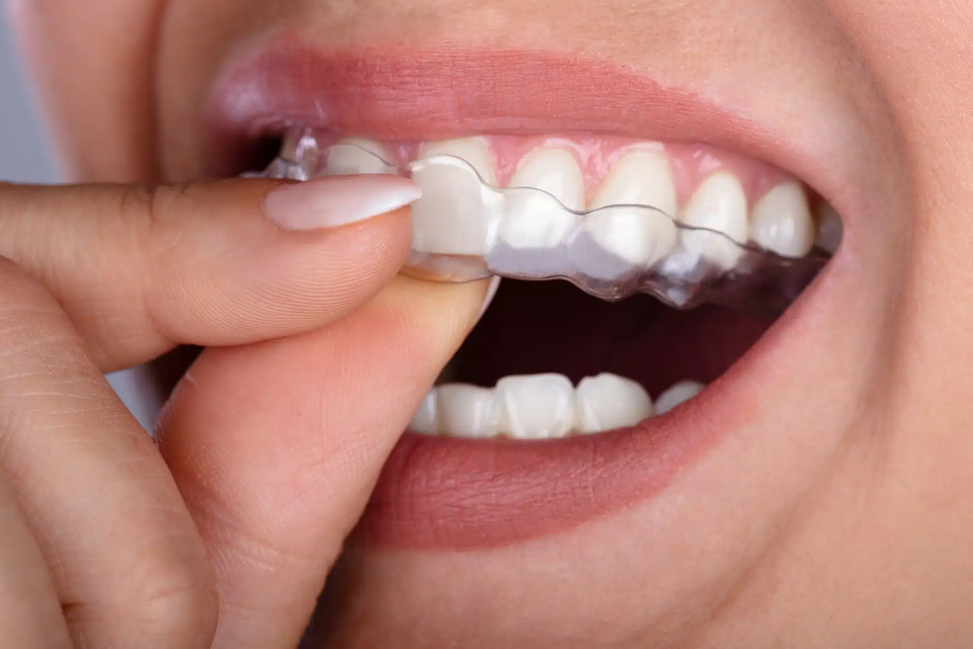 transparent-clear-braces-on-teeth