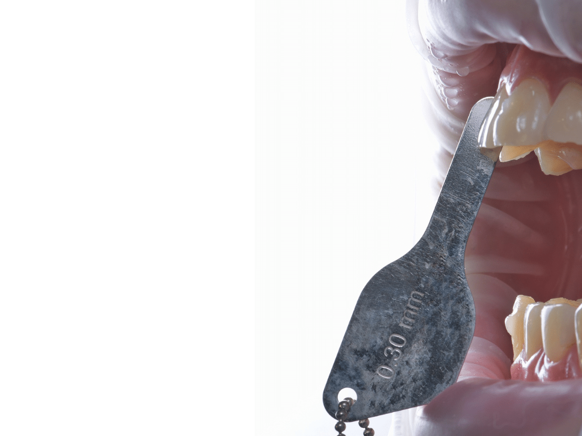 Orthodontic Spacers: Purpose, Pain, and What to Expect | Dr. Lints ...